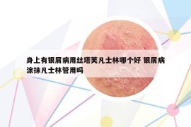 身上有银屑病用丝塔芙凡士林哪个好 银屑病涂抹凡士林管用吗