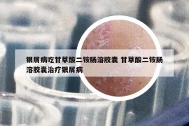 银屑病吃甘草酸二铵肠溶胶囊 甘草酸二铵肠溶胶囊治疗银屑病