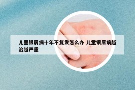 儿童银屑病十年不复发怎么办 儿童银屑病越治越严重