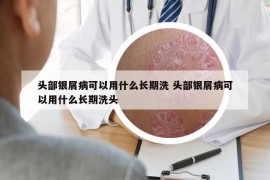 头部银屑病可以用什么长期洗 头部银屑病可以用什么长期洗头