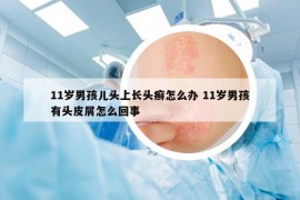 11岁男孩儿头上长头癣怎么办 11岁男孩有头皮屑怎么回事