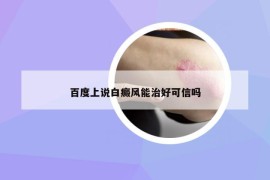 百度上说白癜风能治好可信吗