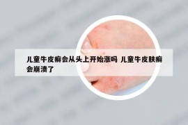 儿童牛皮癣会从头上开始涨吗 儿童牛皮肤癣会崩溃了