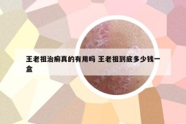 王老祖治癣真的有用吗 王老祖到底多少钱一盒