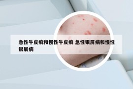 急性牛皮癣和慢性牛皮癣 急性银屑病和慢性银屑病