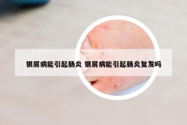 银屑病能引起肠炎 银屑病能引起肠炎复发吗