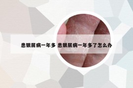 患银屑病一年多 患银屑病一年多了怎么办