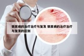 银屑病的治疗治疗与复发 银屑病的治疗治疗与复发的区别