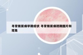 寻常银屑病早期症状 寻常银屑病初期图片和现象