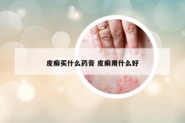 皮癣买什么药膏 皮癣用什么好