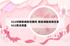 b12对银屑病有效果吗 银屑病服用维生素b12用法用量