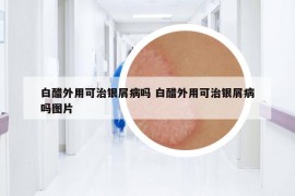 白醋外用可治银屑病吗 白醋外用可治银屑病吗图片