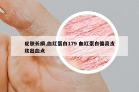 皮肤长癣,血红蛋白179 血红蛋白偏高皮肤出血点