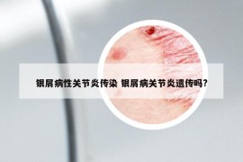 银屑病性关节炎传染 银屑病关节炎遗传吗?