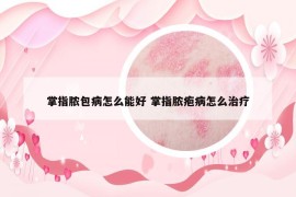 掌指脓包病怎么能好 掌指脓疱病怎么治疗