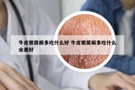 牛皮银屑癣多吃什么好 牛皮银屑癣多吃什么水果好