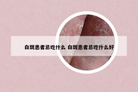 白斑患者忌吃什么 白斑患者忌吃什么好