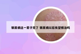 银屑病这一辈子完了 银屑病以后有望根治吗