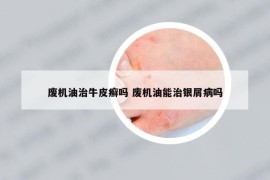 废机油治牛皮癣吗 废机油能治银屑病吗