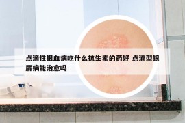 点滴性银血病吃什么抗生素的药好 点滴型银屑病能治愈吗