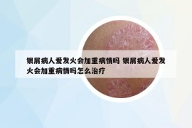 银屑病人爱发火会加重病情吗 银屑病人爱发火会加重病情吗怎么治疗