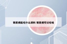 银屑病能吃什么调料 银屑病可以吃啥