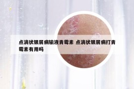 点滴状银屑病输液青霉素 点滴状银屑病打青霉素有用吗