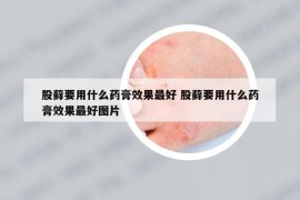 股藓要用什么药膏效果最好 股藓要用什么药膏效果最好图片