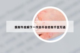 我有牛皮癣下一代会不会也有千言万语