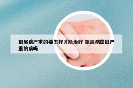 银屑病严重的要怎样才能治好 银屑病是很严重的病吗