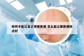 如何才能让自己得银屑病 怎么能让银屑病快点好