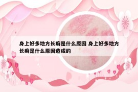 身上好多地方长癣是什么原因 身上好多地方长癣是什么原因造成的