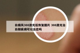 白癜风308激光后恢复图片 308激光治白颠疯病可以治愈吗