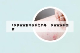 1岁多宝宝有牛皮癣怎么办 一岁宝宝皮癣图片