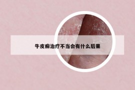 牛皮癣治疗不当会有什么后果