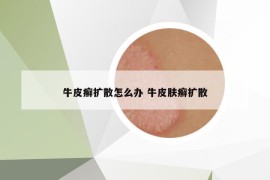 牛皮癣扩散怎么办 牛皮肤癣扩散