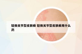 轻微关节型皮肤癣 轻微关节型皮肤癣用什么药