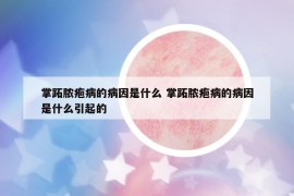 掌跖脓疱病的病因是什么 掌跖脓疱病的病因是什么引起的