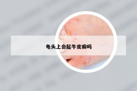 龟头上会起牛皮癣吗