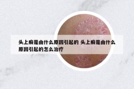 头上癣是由什么原因引起的 头上癣是由什么原因引起的怎么治疗