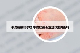 牛皮癣被蚊子咬 牛皮肤癣会通过蚊虫传染吗