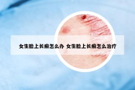 女生脸上长癣怎么办 女生脸上长癣怎么治疗