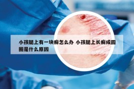 小孩腿上有一块癣怎么办 小孩腿上长癣成圆圈是什么原因