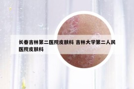 长春吉林第二医院皮肤科 吉林大学第二人民医院皮肤科