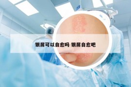 银屑可以自愈吗 银屑自愈吧