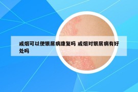 戒烟可以使银屑病康复吗 戒烟对银屑病有好处吗