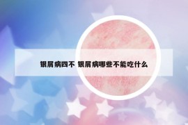 银屑病四不 银屑病哪些不能吃什么