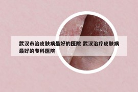 武汉市治皮肤病最好的医院 武汉治疗皮肤病最好的专科医院
