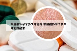 银屑病怀孕了多久才能好 银屑病怀孕了多久才能好起来