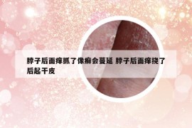 脖子后面痒抓了像癣会蔓延 脖子后面痒挠了后起干皮